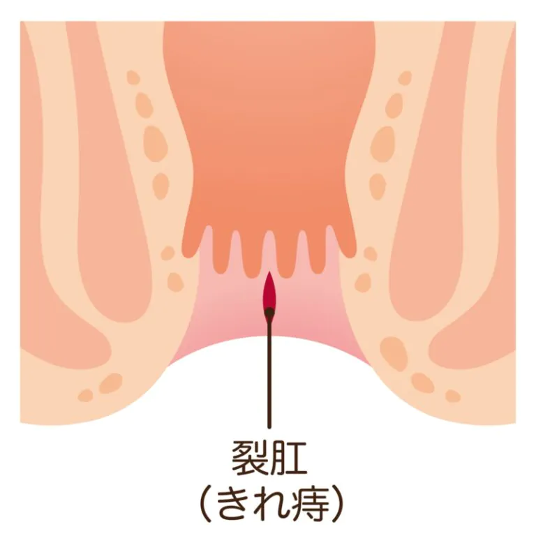 切れ痔（裂孔）