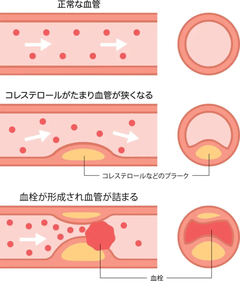 脂質異常症とは